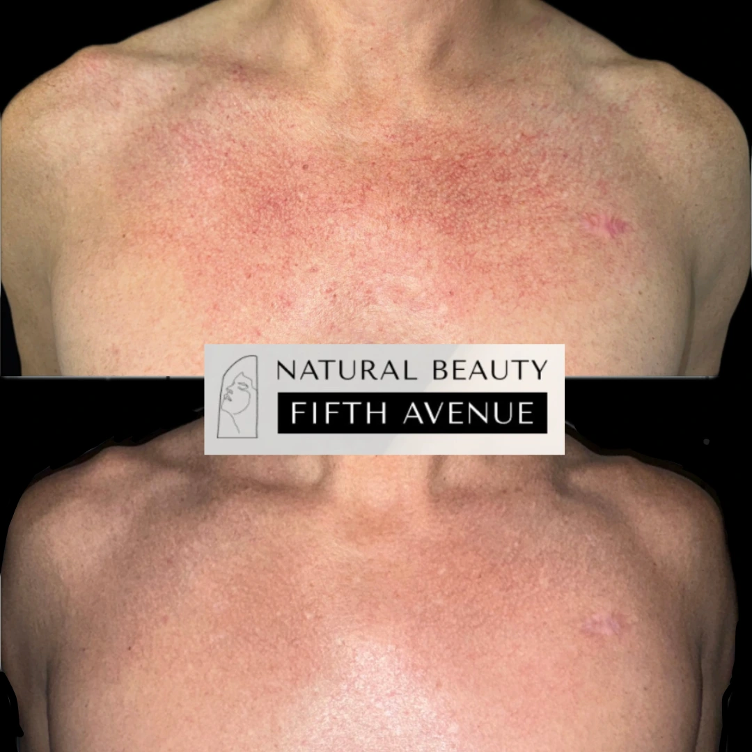 Patient's chest and shoulders showing uneven skin tone with redness before medical dermatology treatment